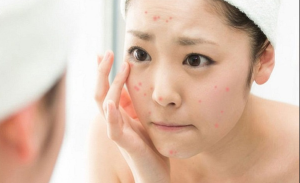 Những điều nên tránh sau khi nặn mụn