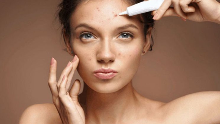 Cách chăm sóc da sau khi nặn mụn hiệu quả và an toàn