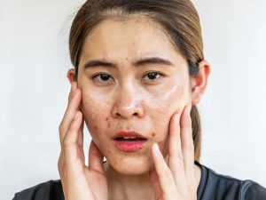 Tại sao cần quy trình skincare riêng cho da dầu mụn?