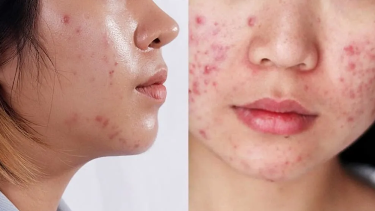 Quy trình skincare cho da dầu mụn buổi sáng và buổi tối